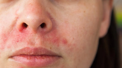 How can you treat Perioral Dermatitis?